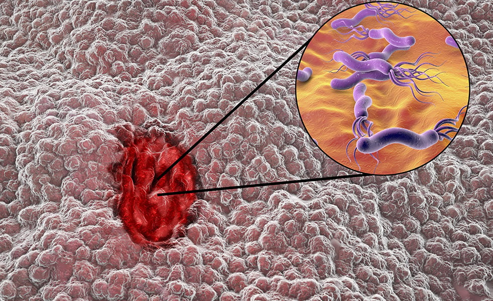 disturbi-gastrici-quando-la-causa-è-l'helicobacter-pylori-1-biochetasi